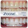 Phillips Zoom Nite White 22% - 3 Syrings