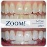 Phillips Zoom Day White 9.5% - 3 Syringes trays